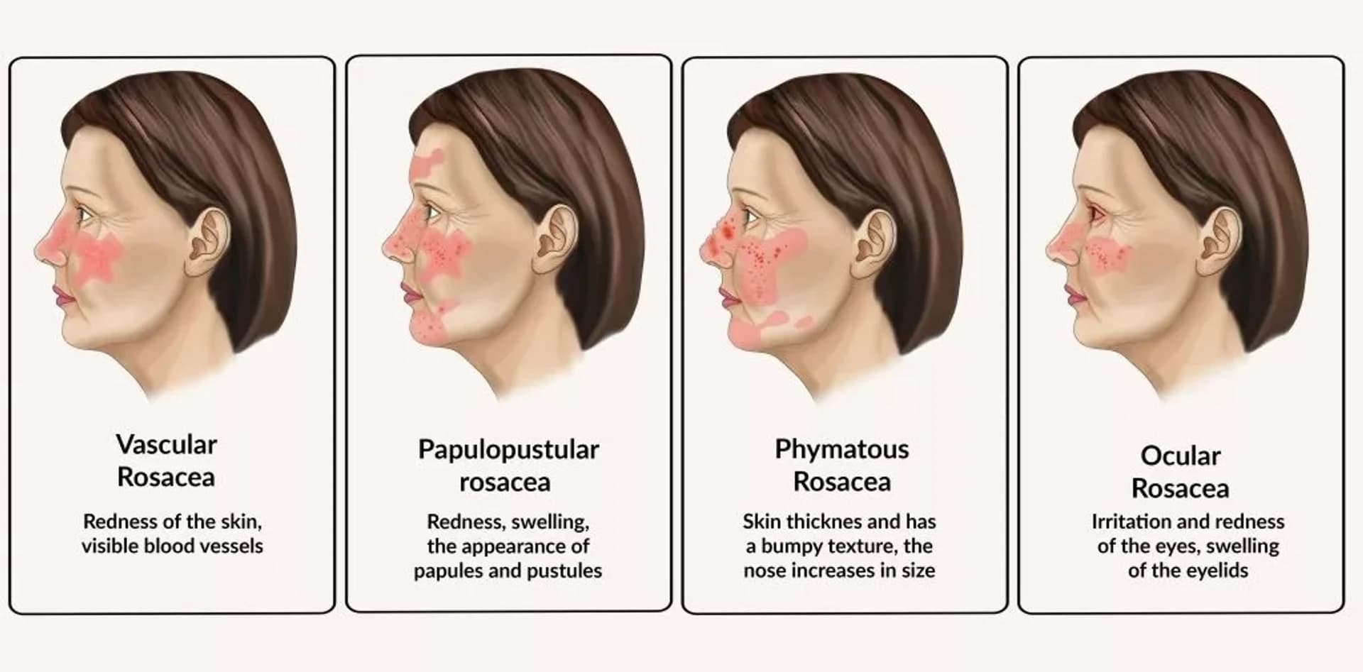 Rosácea e seus gatilhos: guia detalhado