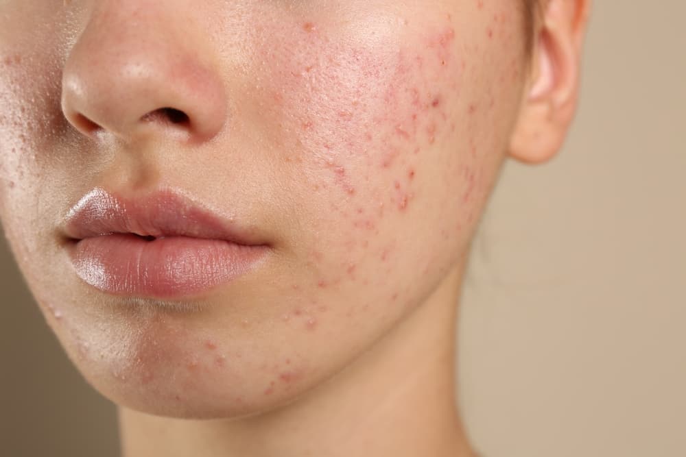 Acne