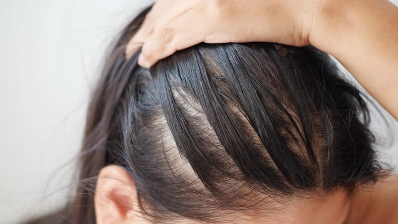 Perda de cabelo