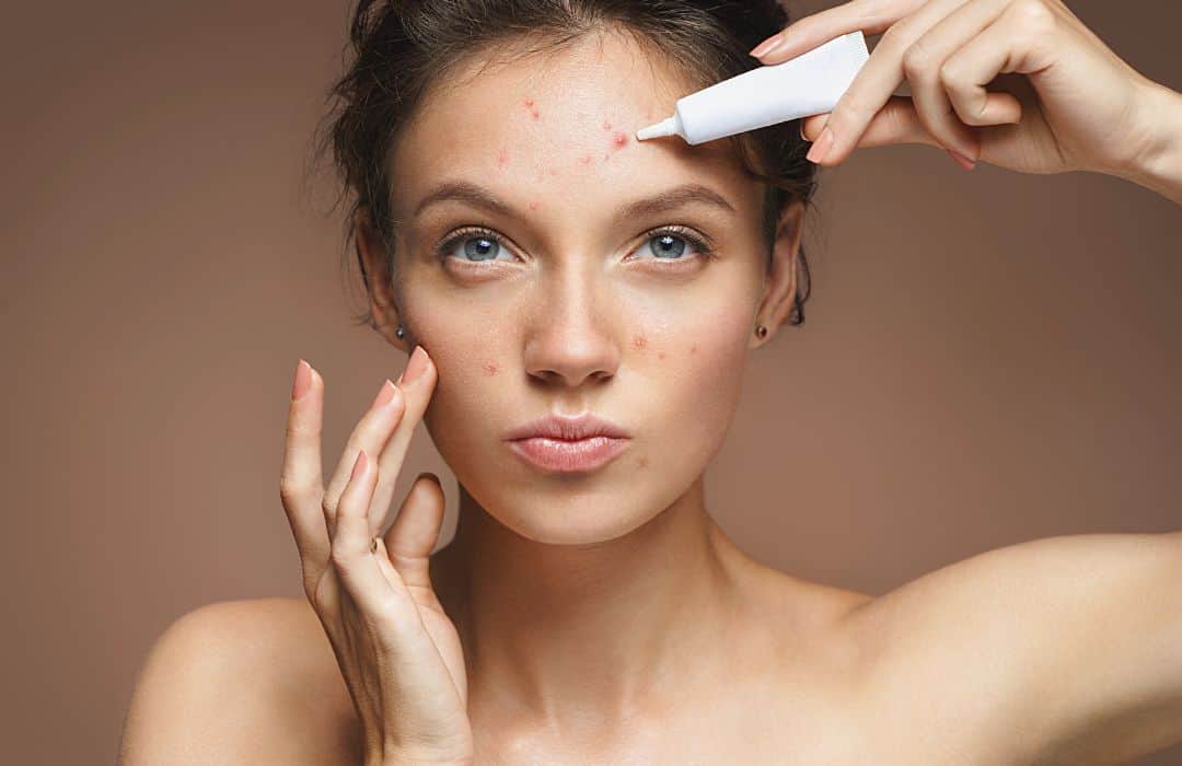 Peróxido de benzoíla — uma solução eficaz para eliminar acne