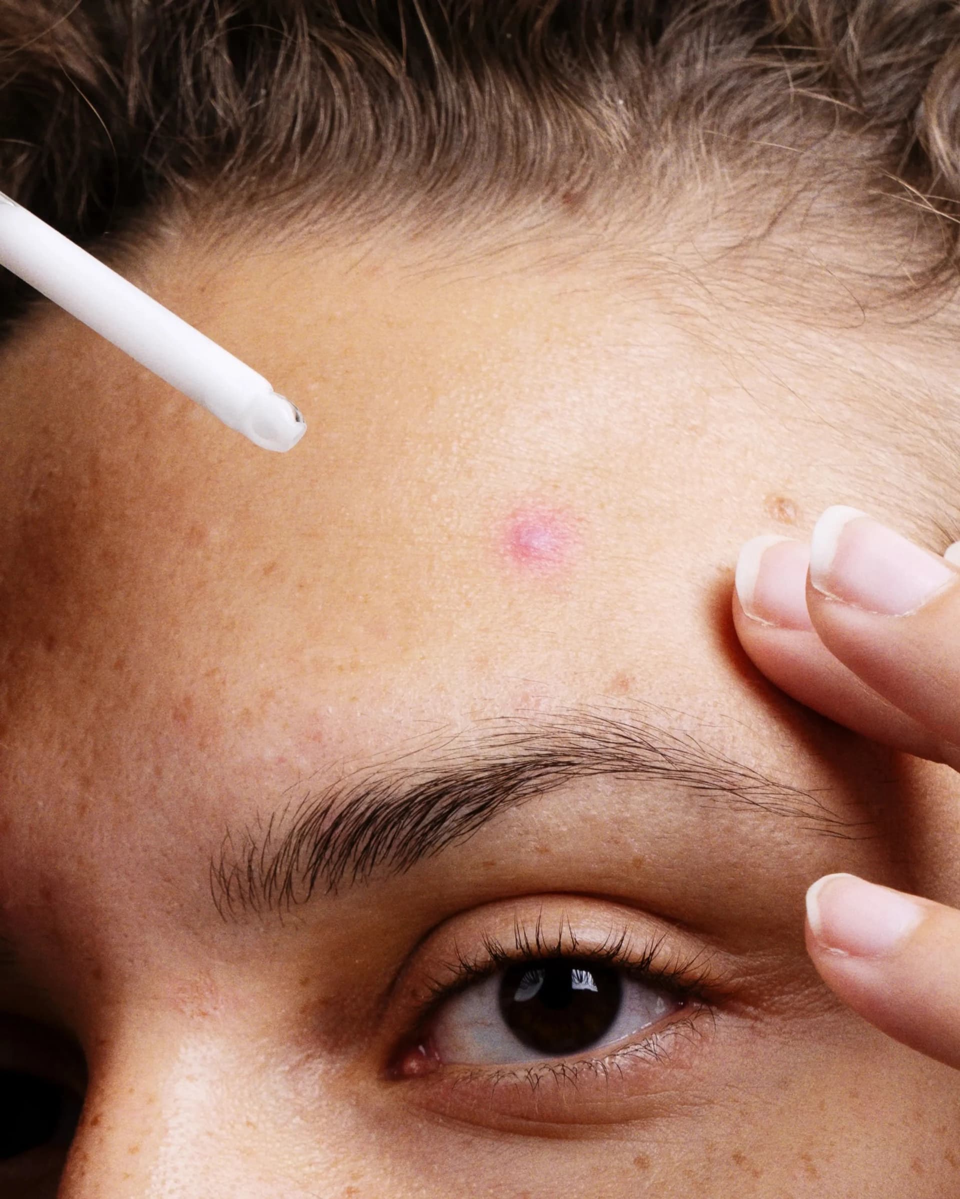 A niacinamida ajuda contra a acne?