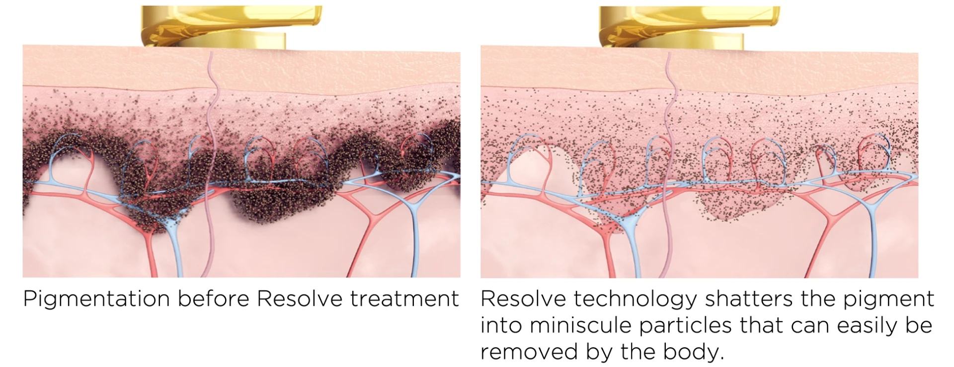 Como tratar manchas senis nas mãos?
