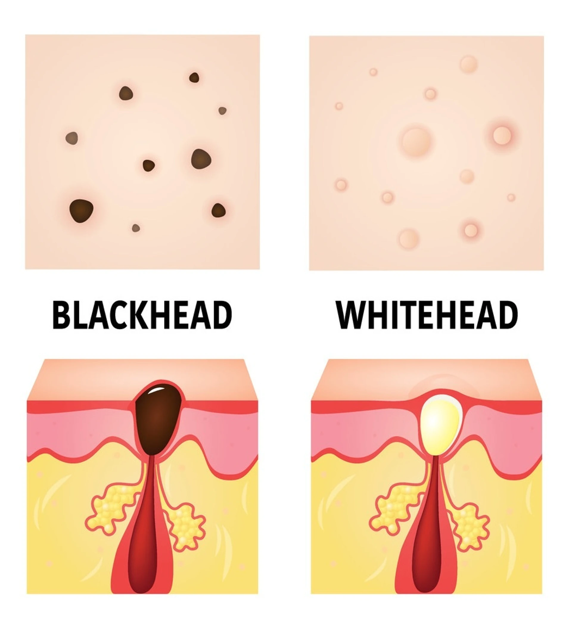 Comedões: abertos e fechados