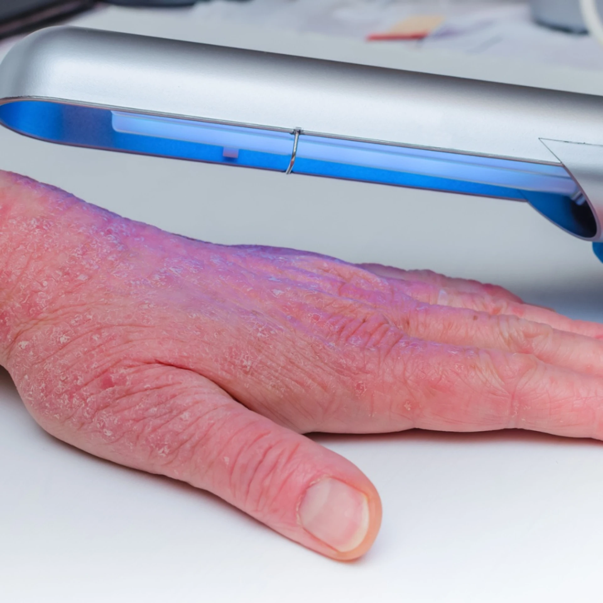 Abordagens alternativas para o tratamento do eczema crônico das mãos