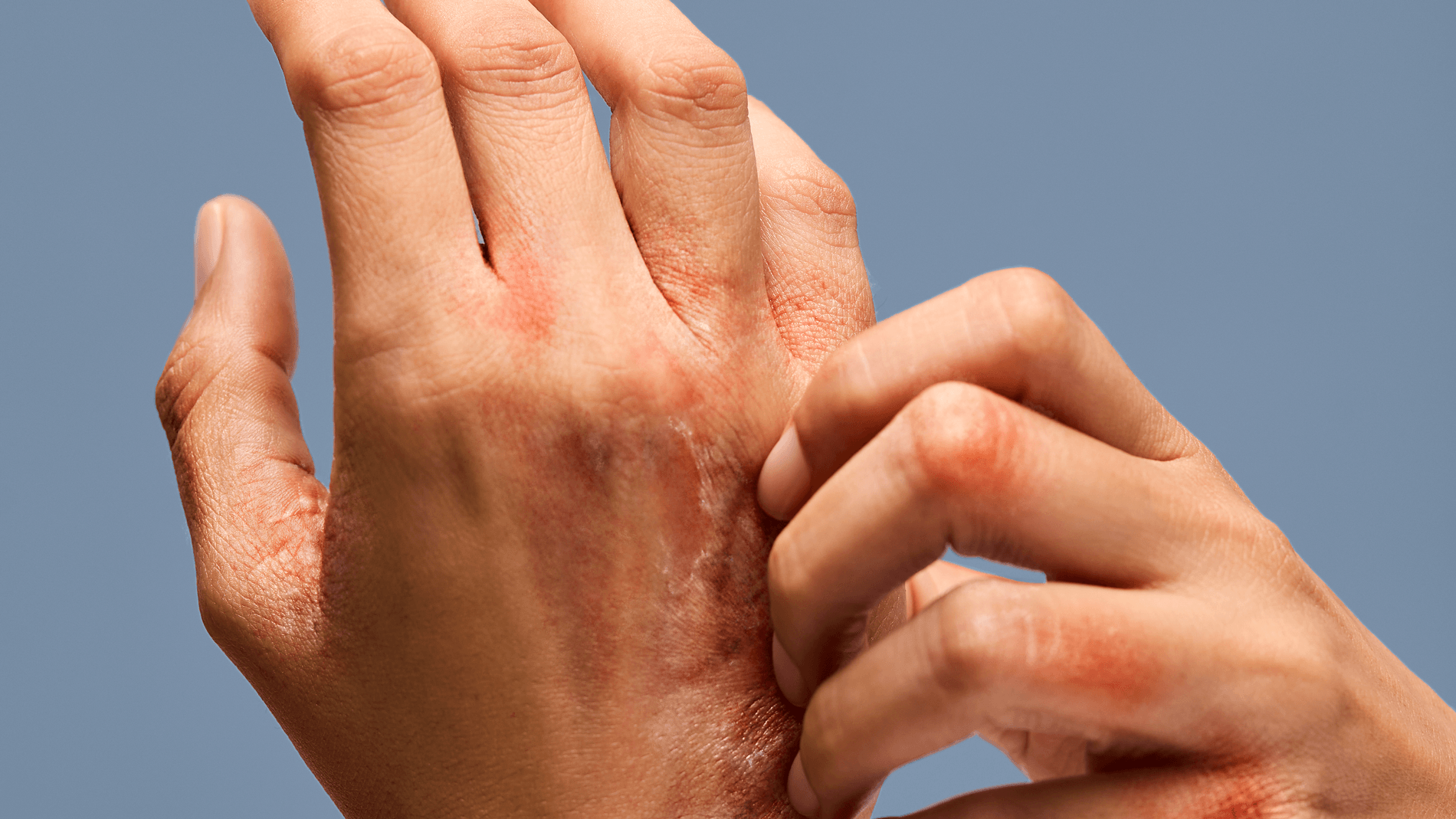 Abordagens alternativas para o tratamento do eczema crônico das mãos