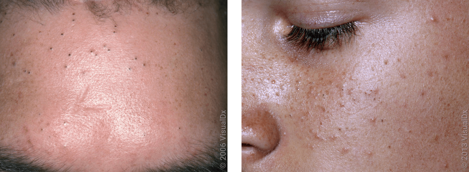 Visão geral dos principais tipos de acne