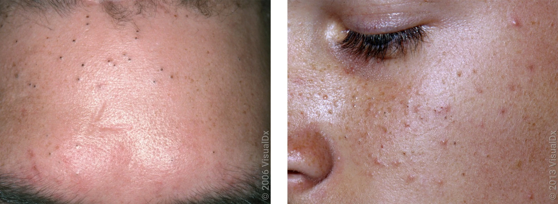 Visão geral dos principais tipos de acne
