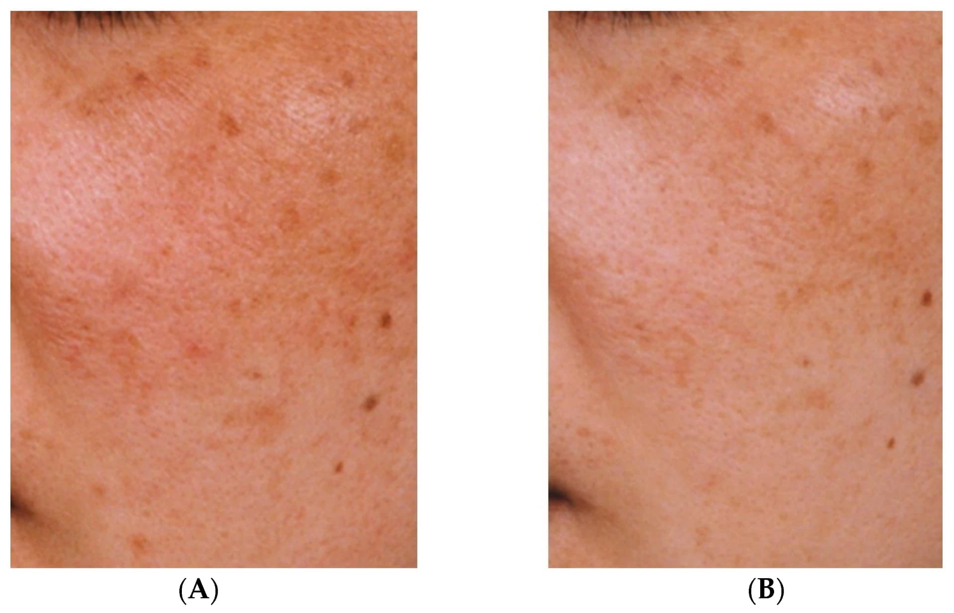 Ácido tranexâmico: um tratamento eficaz contra a hiperpigmentação
