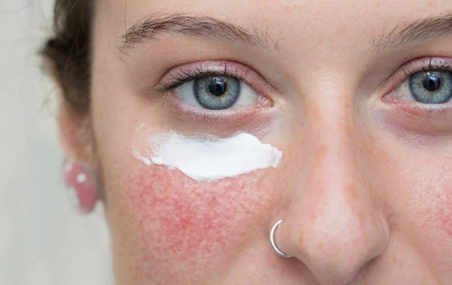 Benefícios do ácido azelaico para a rosácea