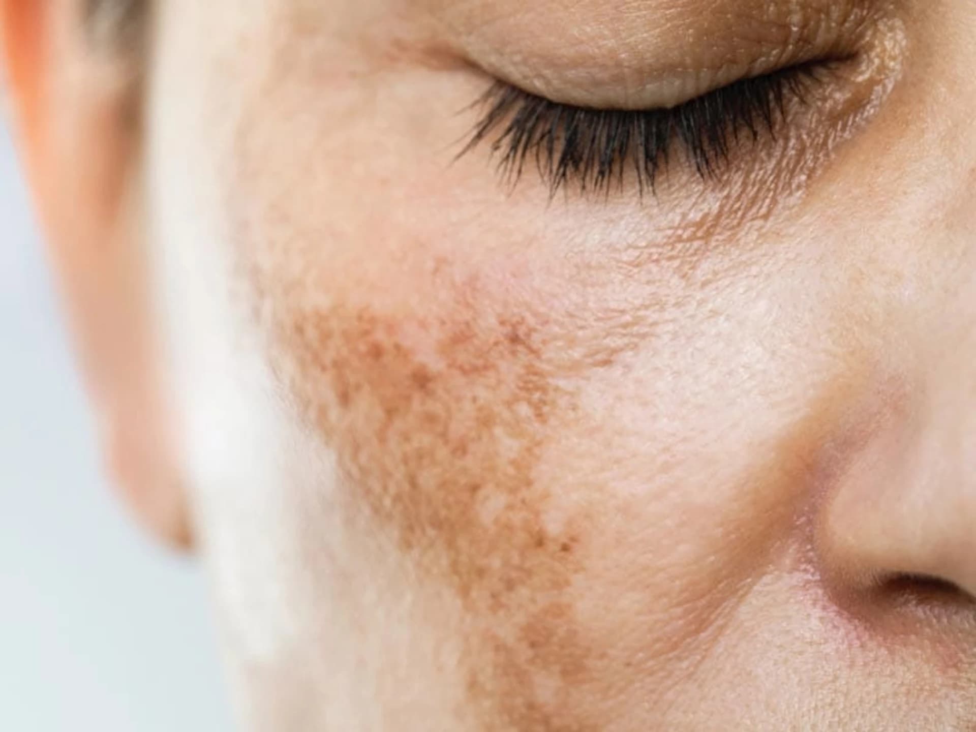 Top 9 ingredientes para reduzir a pigmentação