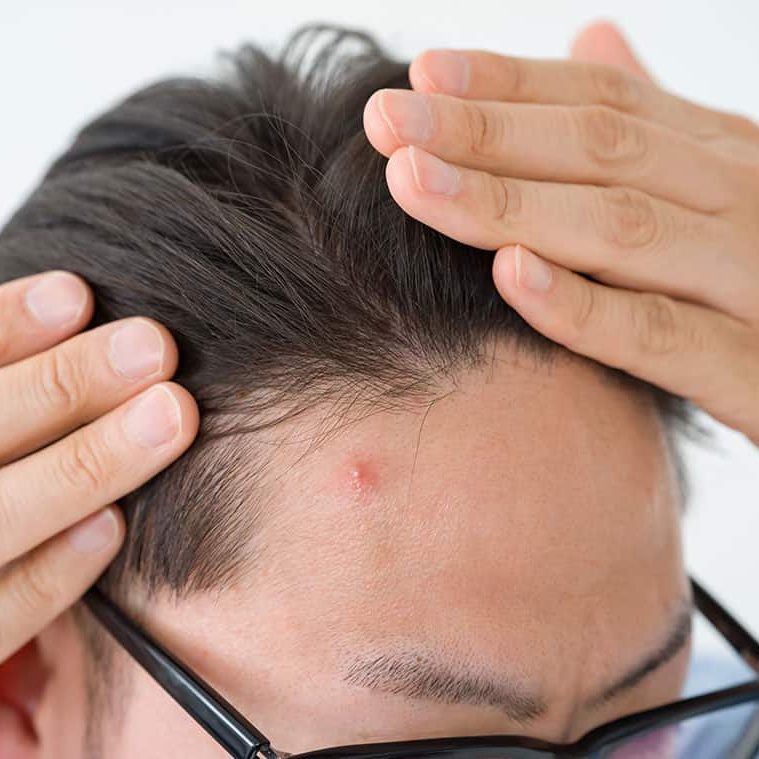 Compreendendo a acne da linha do cabelo (couro cabeludo): causas, prevenção e tratamentos eficazes