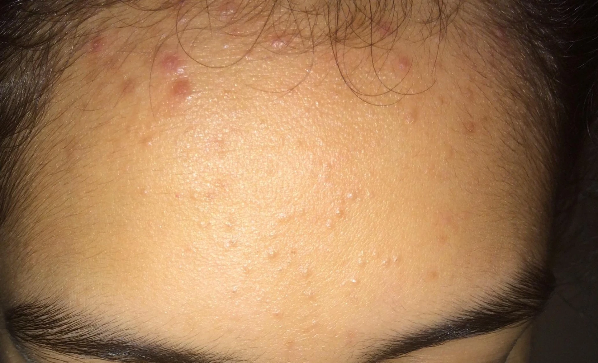 Compreendendo a acne da linha do cabelo (couro cabeludo): causas, prevenção e tratamentos eficazes